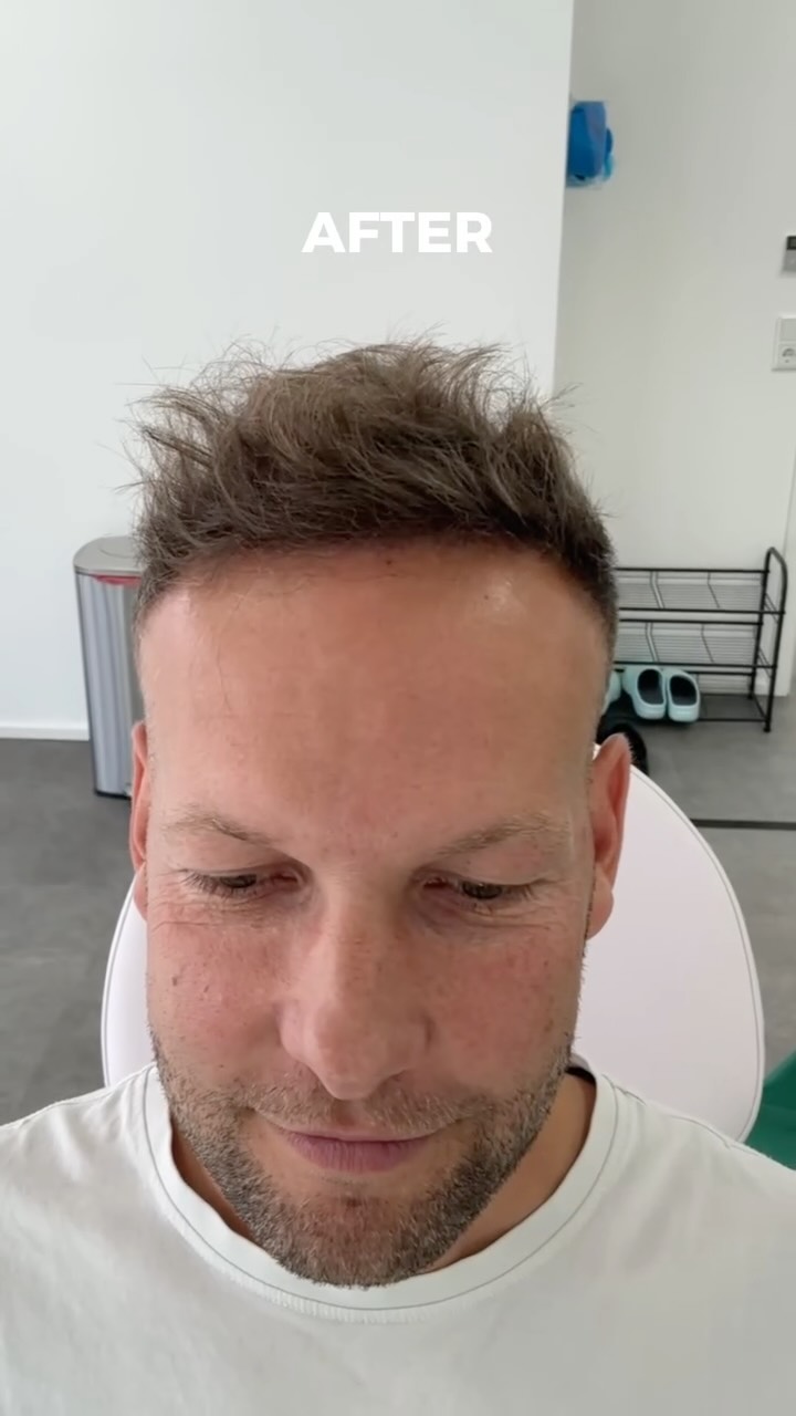 Woran erkennt man eine gute Haartransplantation? | Hair Genesis…