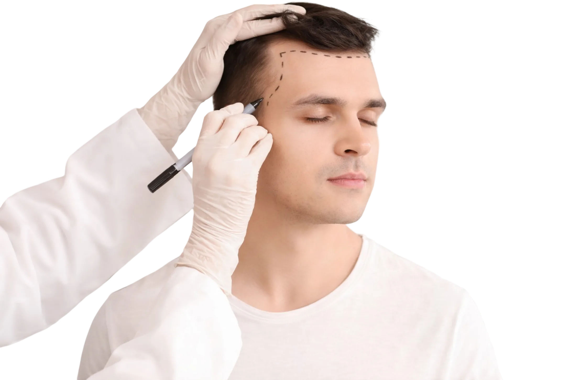 Anzeichnen der neuen Haarlinie vor einer Haartransplantation