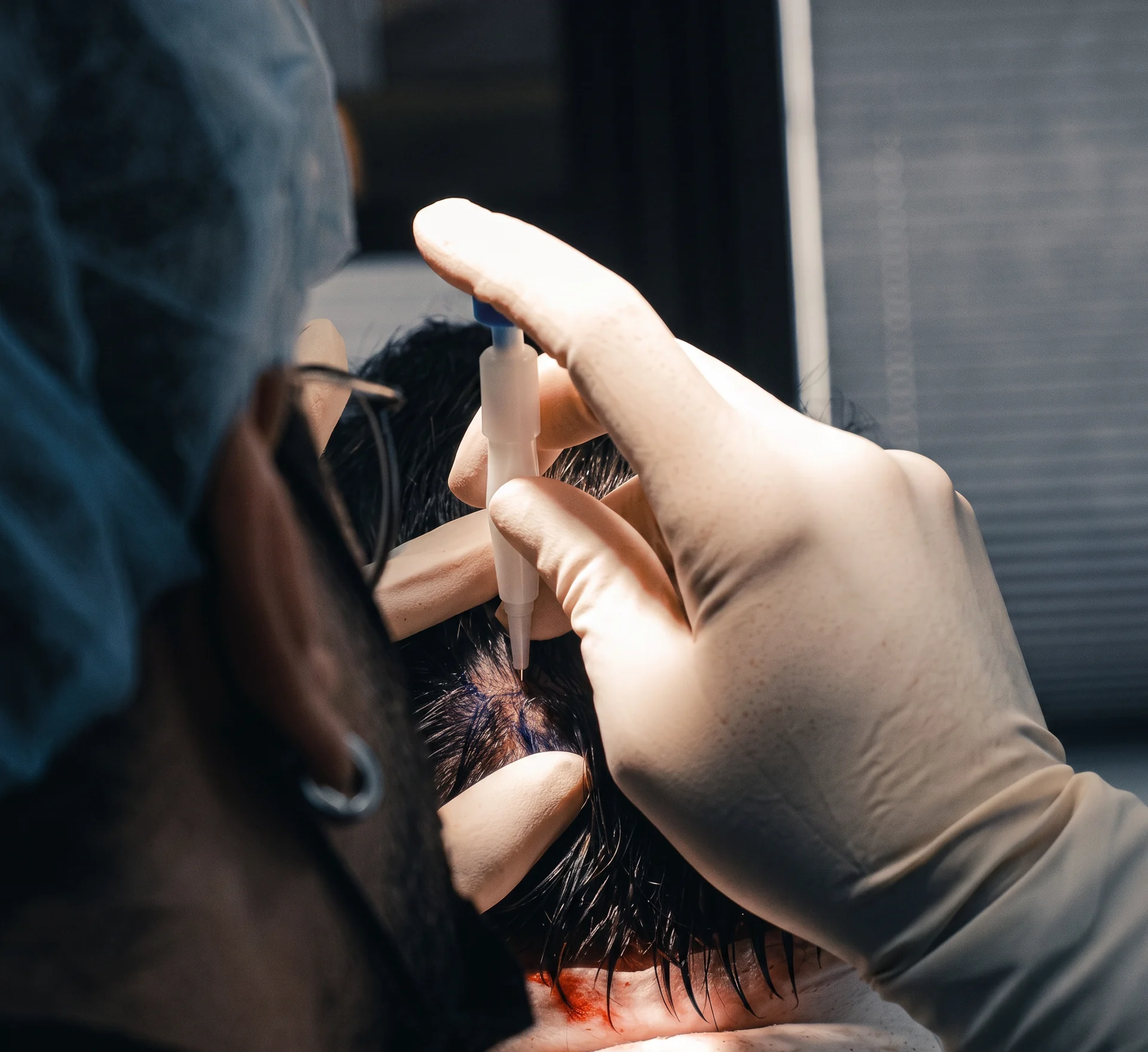 DHI-Haartransplantation in der Praxis