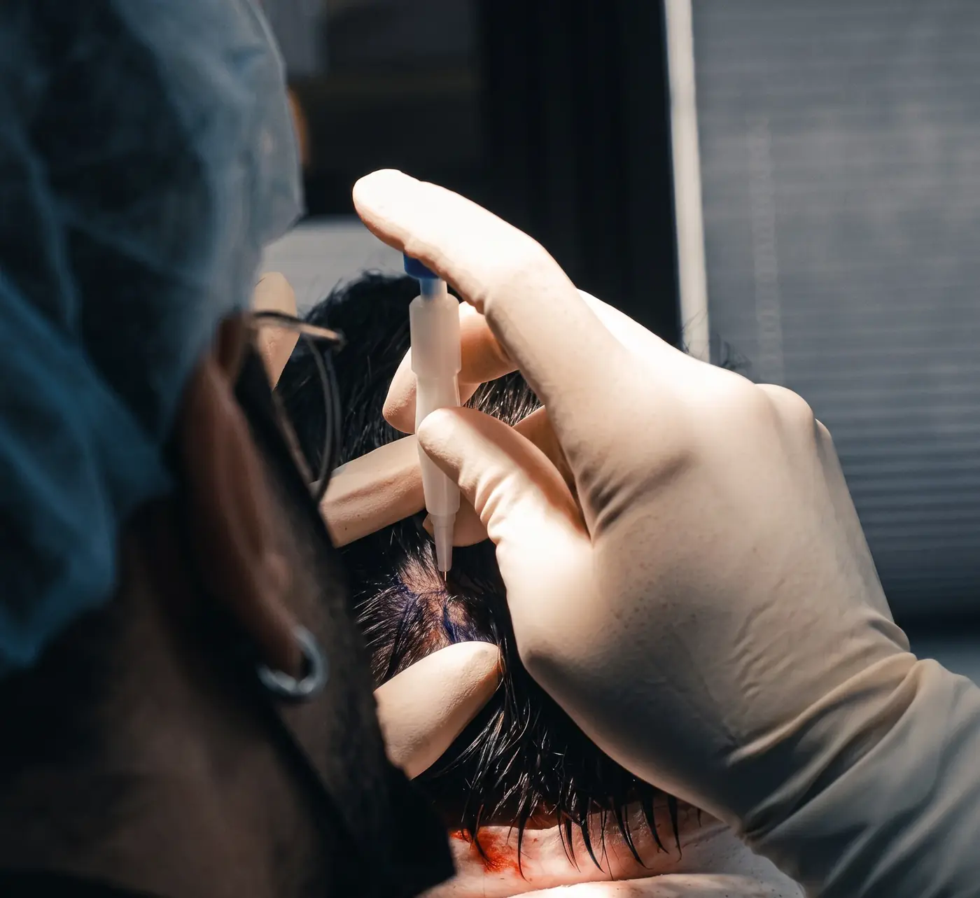 DHI-Haartransplantation in der Praxis